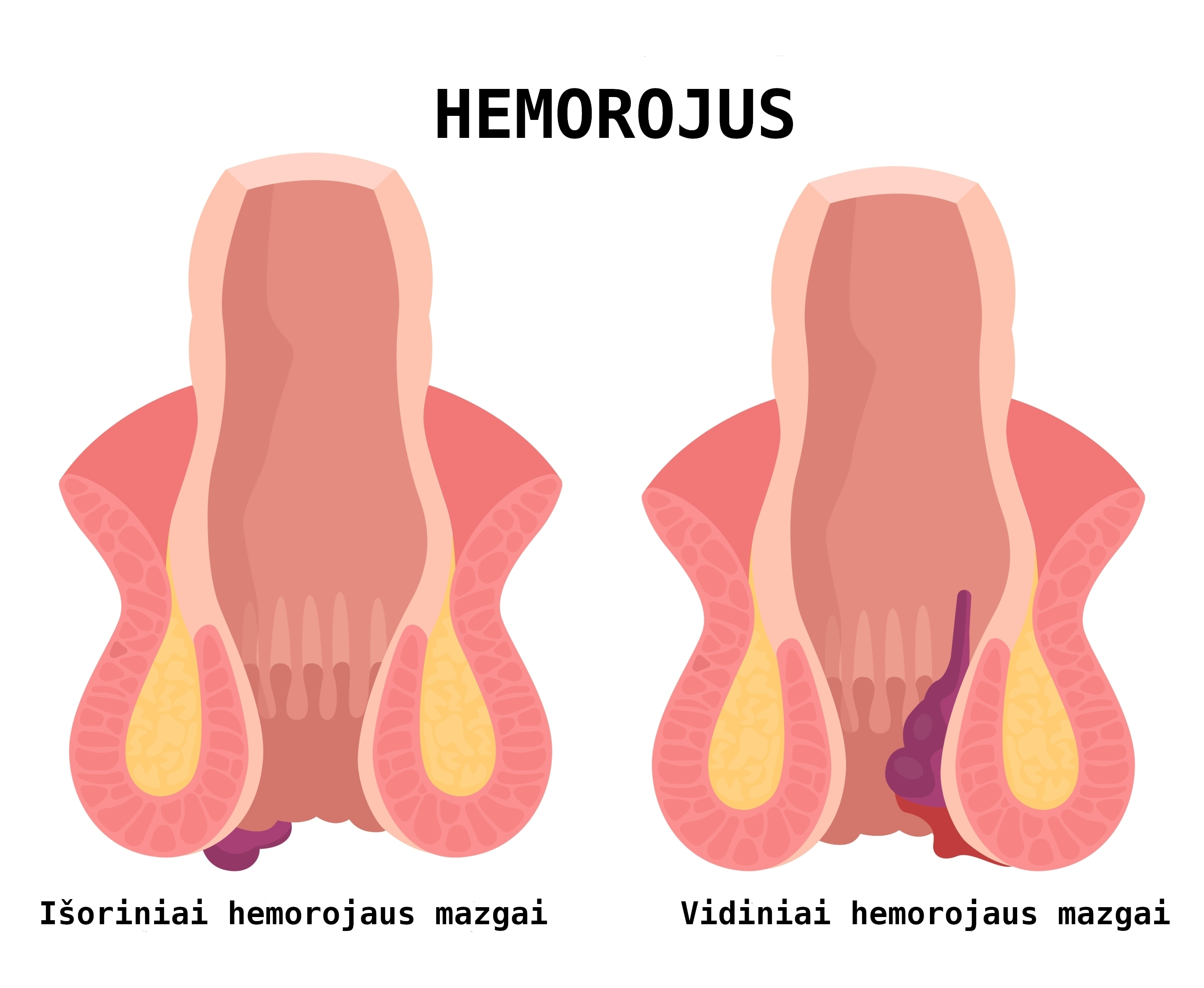Hemorojus, išoriniai ir vidiniai mazgai